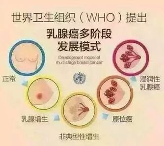 乳癌发展阶段.jpg